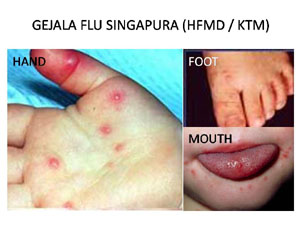 Pengobatan Penyakit Flu Singapura